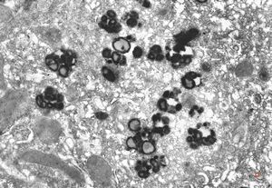 M,16y. | lipofuscin - hyperbilirubinaemia - Gilbert or Dubin-Johnson syndrome M,16y. | lipofuscin - hyperbilirubinaemia - Gilbert or Dubin-Johnson syndrome